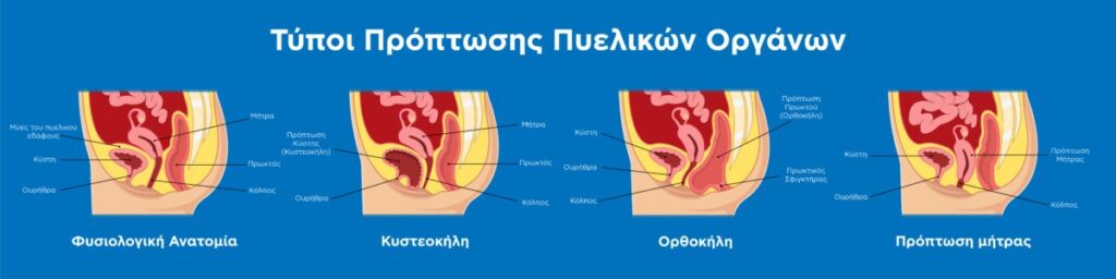 Αποκόλληση πλακούντα