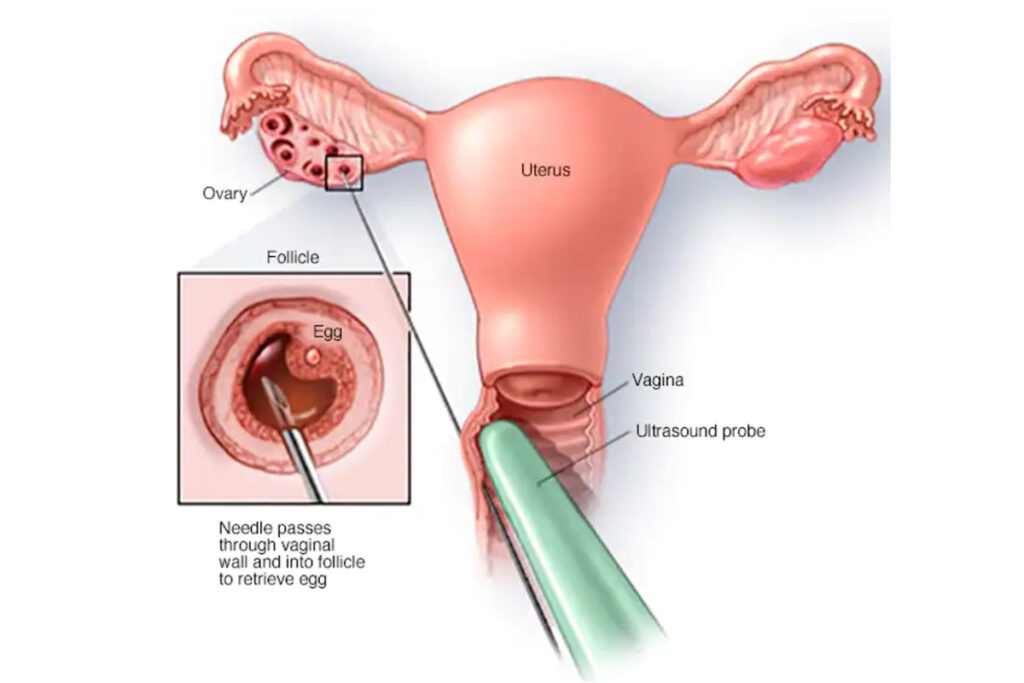 Εξωσωματική σε φυσικό κύκλο και Mini IVF